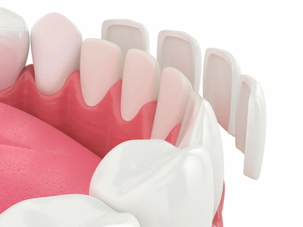 Alles über Veneers Mit Keramikschalen zum weißen Lächeln
