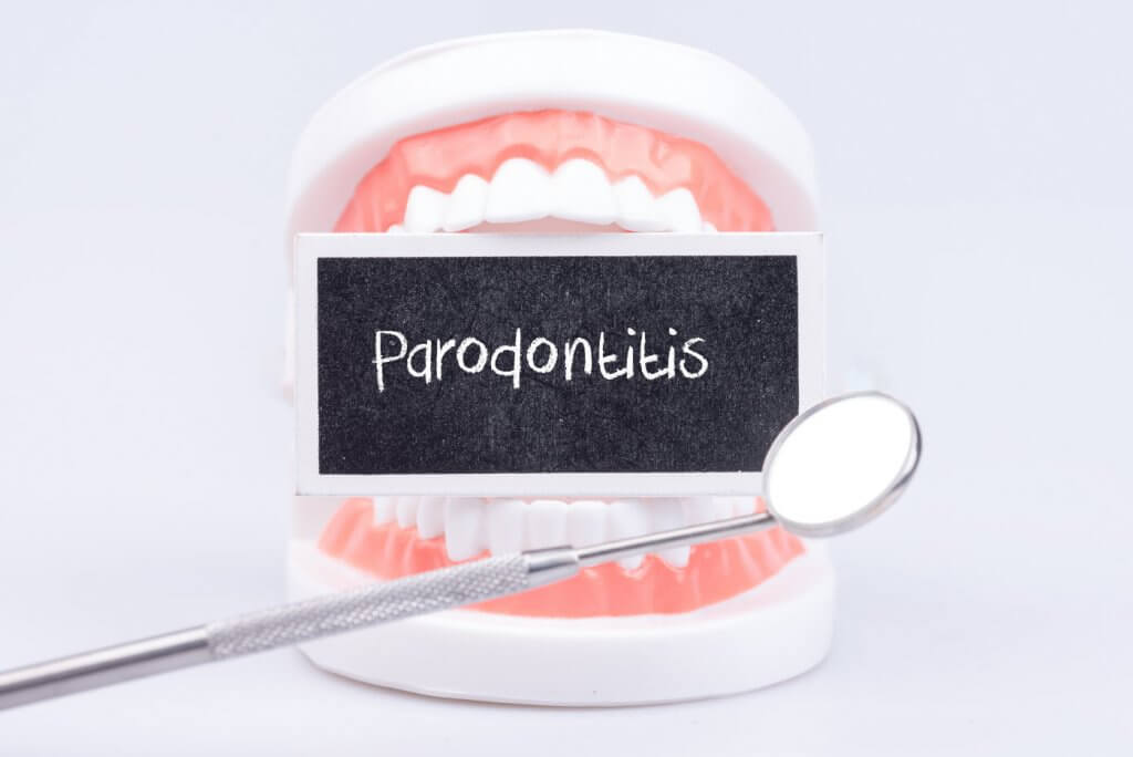Parodontitis